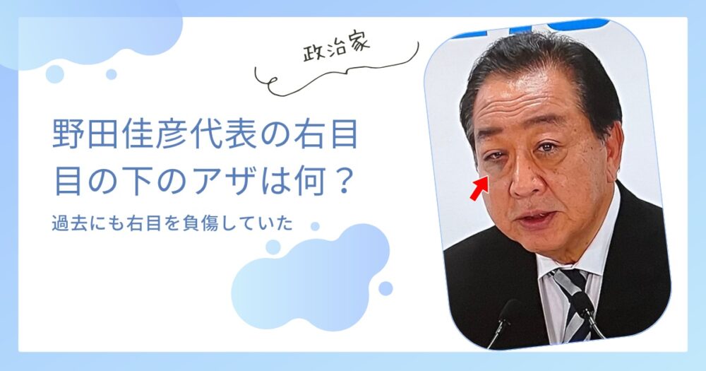 【立憲】野田佳彦の右目のアザは何？過去にも怪我で目に眼帯してた